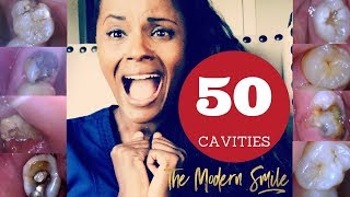 50 Cavities photos with treatment narrated by dentist [upl. by Ael]