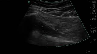 Piriformis Injection  Ultrasound Guided Injections  Nashville Hip Institute [upl. by Tenrag]