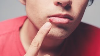 Dermatologist explains causes of cold sores [upl. by Novel47]