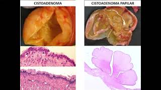 Generalidades de neoplasias I [upl. by Augusta]