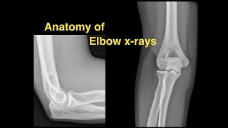 Anatomy of Elbow Xrays [upl. by Etteyafal500]