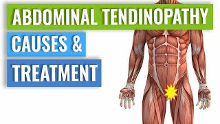 Abdominal Tendinopathy  Causes and Treatment Including Exercises [upl. by Lledrac573]