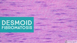 Desmoid Fibromatosis Desmoid Tumor  Explained by a Soft Tissue Pathologist [upl. by Dee Dee]