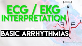 Basic Arrhythmias  Sinus Brady Tachy Premature Beats  ECG EKG Interpretation Part 3 [upl. by Araek]