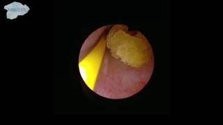 Cystoscopy and placement of guidewire [upl. by Secrest]