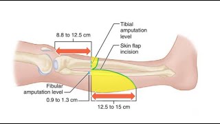 Transtibial Below Knee Amputation for the Ischemic Limbs [upl. by Kroo]