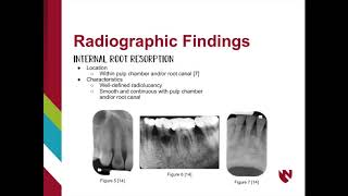 Internal or External Root Resorption [upl. by Holms126]