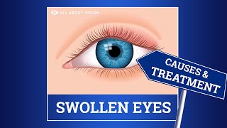 Swollen Eyelid Causes amp Treatment [upl. by Enamart]