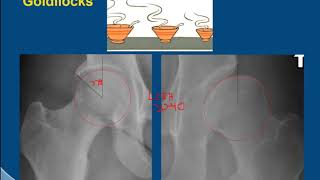 A Review Of Acetabular Fractures  Everything You Need To Know  Dr Nabil Ebraheim [upl. by Jeroma]