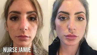 Before and After Micro Needling  Nurse Jamie [upl. by Floria]