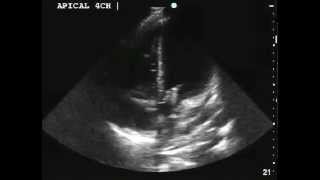 Aortic and Mitral Valve Endocarditis [upl. by Onra]