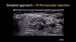 USguided Axillary Brachial Plexus Block  the Simple Guide [upl. by Yttig]