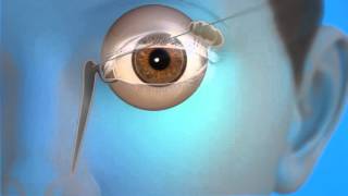 Tear Duct Probing Surgery [upl. by Midas]