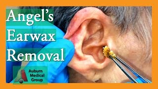 Angels Earwax Removal  Auburn Medical Group [upl. by Joses]