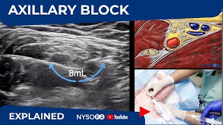 Ultrasound Guided Axillary Brachial Plexus Block NYSORA Regional Anesthesia [upl. by Eissel]