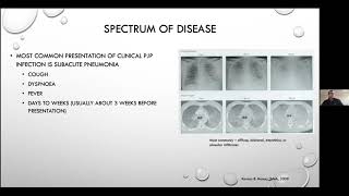 Pneumocystis jirovecii pneumonia  Current Issues in its Management [upl. by Cul]