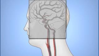 Neuro Embolization Procedure [upl. by Anivla]