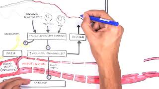 Burns  Pathophysiology [upl. by Araiet]