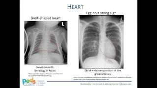 Approach to Pediatric Chest XRays [upl. by Kanal]