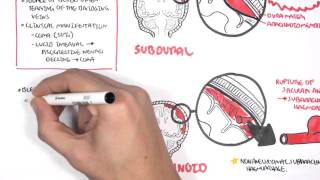 Intracranial Haemorrhage Types signs and symptoms [upl. by Kinzer58]