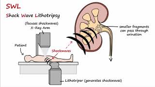 How To Dissolve Kidney Stones Explained By DrBerg [upl. by Atikan]