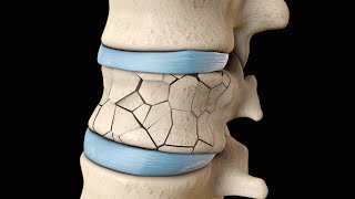 Back Surgery  Vertebroplasty and Kyphoplasty  Nucleus Health [upl. by Ahsias]