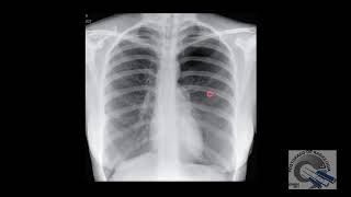 Neumotórax ¿Cómo se ve en radiografías [upl. by Yliah]