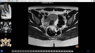 Female Pelvis MRI [upl. by Aihcela483]