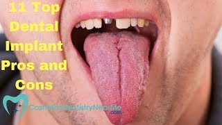 11 Top Dental Implant Pros and Cons [upl. by Llerryt25]