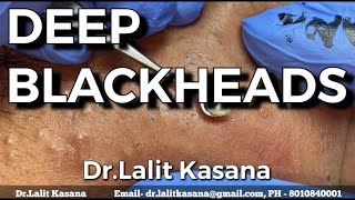 DEEP OLD BLACKHEADS REMOVAL BY DrLalit Kasana 24 Jan 2020 [upl. by Juakn201]