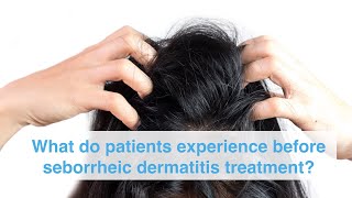 What do patients experience before seborrheic dermatitis treatment [upl. by Ajtak]