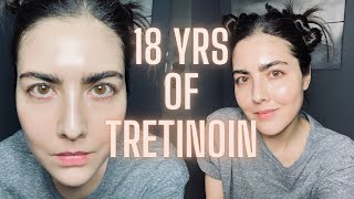 Not Seeing Results with RetinA TRETINOIN Watch This Before You Quit amp Avoid My Biggest Mistake [upl. by Llyrehc61]