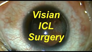 Visian ICL implantable contact lens and bioptics 51611 Shannon Wong MD [upl. by Beau]