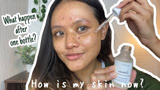 THE ORDINARY NIACINAMIDE 10  ZINC 1 review after one bottle UPDATED REVIEW⎮English [upl. by Yrrej]