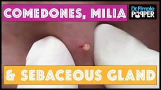 A Dr Pimple Popper Medley Heavy on the Blackheads [upl. by Sorkin]