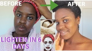 How I How i BRIGHTENED MY SKIN IN 6 DAYS REALISTIC and Natural way to reduce hyperpigmentation [upl. by Zink219]