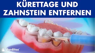 Parodontosebehandlung  Kürettage und Zahnstein entfernen © [upl. by Oran]