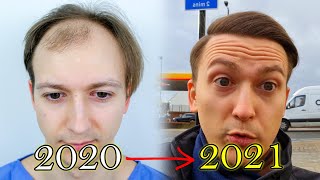 FUE Hair Transplant Growth Timeline  Before amp After [upl. by Perloff]