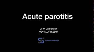 Acute parotitisUSG features [upl. by Nnaear]