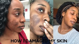 HOW I DAMAGED MY SKIN LEARN FROM MY MISTAKES  SKINCARE [upl. by Hilde798]