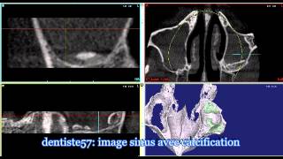 calcification sinus [upl. by Oswin]