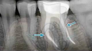 What is Endodontics [upl. by Soisinoid]