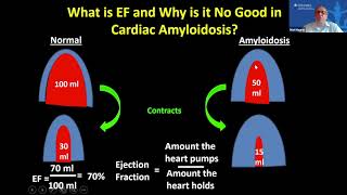 Cardiac Amyloidosis by Dr Mat Maurer [upl. by Ahgem]