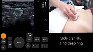 Ultrasound Tutorial InguinalFemoral Hernia Assessment  Radiology Nation [upl. by Napas]