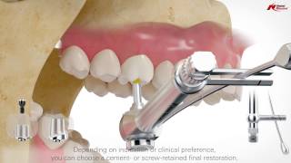 On1 concept intraoral scanning  Nobel Biocare [upl. by Eidnyl]