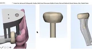 Current Concepts in Radial Head Fractures [upl. by Yroger81]