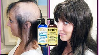 Best Hair Loss Shampoo 2021  The Ultimate Solution [upl. by Ahsoj]