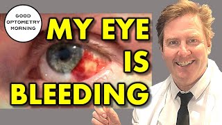 🔴 How to Get Rid of Pink Eye  3 Must Know Facts About Pink Eye and Conjunctivitis [upl. by Ennayelhsa]