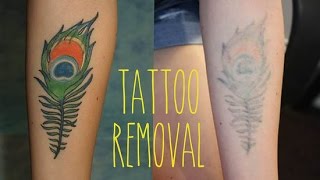 How to Remove a Tattoo  The Most Effective Treatment [upl. by Beora]