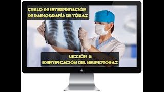 CURSO DE INTERPRETACIÓN DE RADIOGRAFÍA DE TÓRAX IDENTIFICACIÓN DEL NEUMOTÓRAX [upl. by Anibas634]